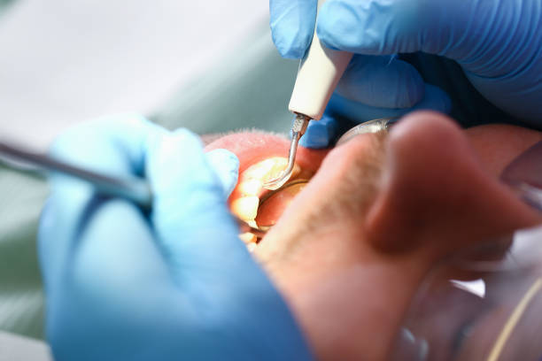 Best Emergency Tooth Extraction in Bellevue, PA